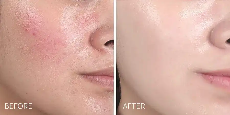 Salicylic Acid Pure Powder Salicylic Acid Pure Powder