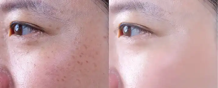 Kojic acid dipalmitate Kojic acid dipalmitate