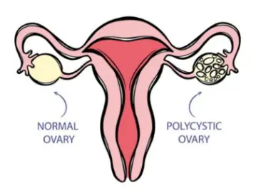 D Chiro Inositol Powder D Chiro Inositol Powder